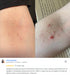 Eczema less® Treatment Cream | ALOE ACTIVE™ - Eczema Treatment Cream